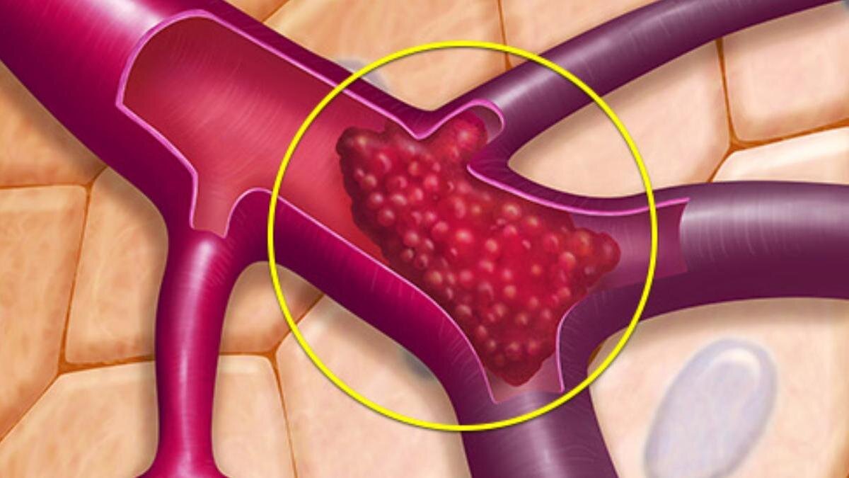 Тромбоз артерия и вена. Микрососудистый тромбоз. Эмболия артерий и сосудов. Тромботическая эмболия.