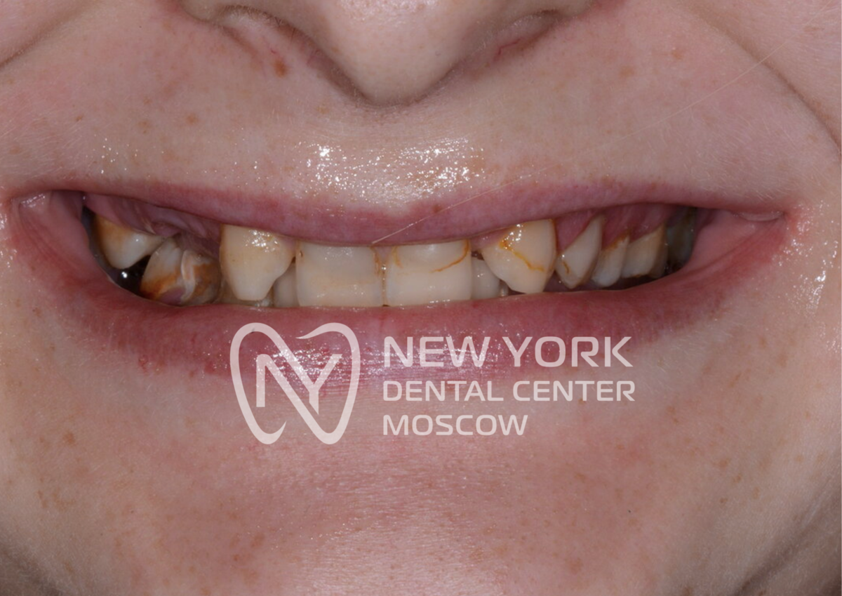 Зона улыбки пациентки "До"