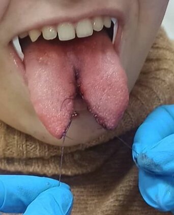 07.01.2021 после наложения швов