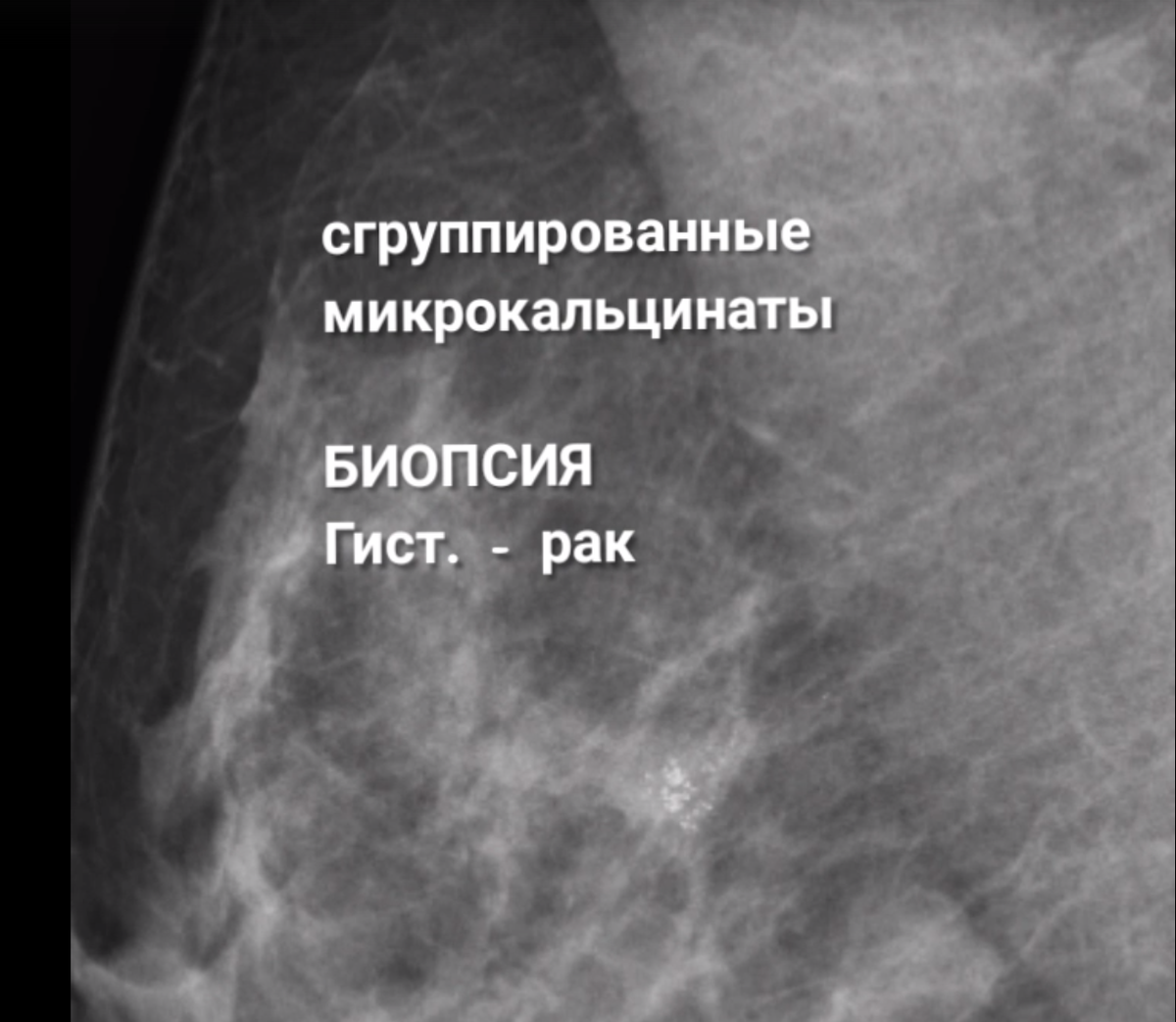 Микрокальцинаты в молочной Микрокальцинаты в молочной