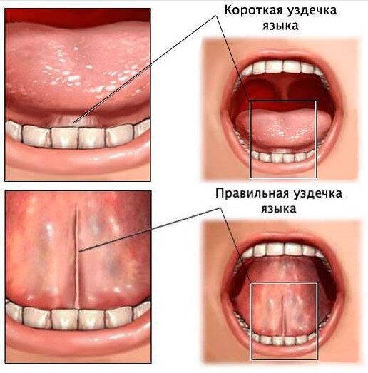 Комплекс упражнений для растяжения подъязычной связки («уздечки»).