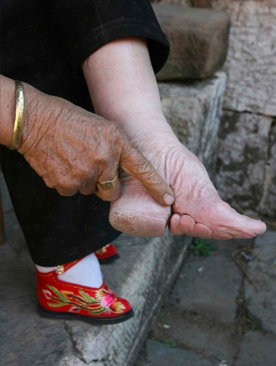 Ноги китайских «женщин-лотосов». 
Фото из общего доступа в интернет пространстве. 