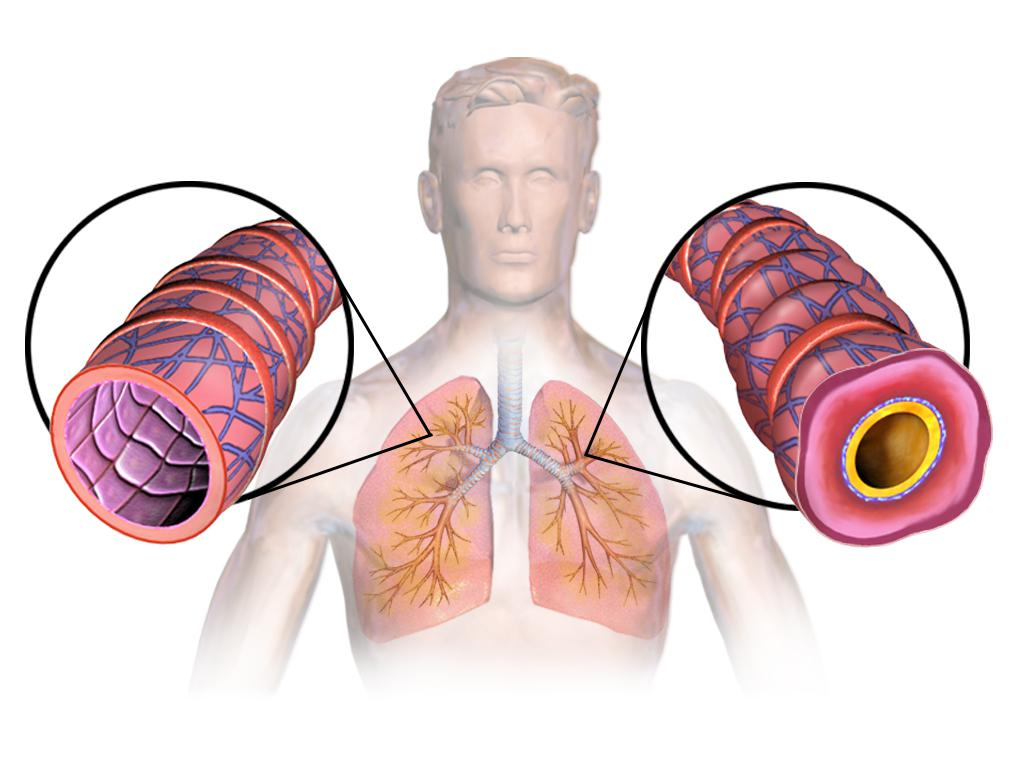 Астма заболевание дыхательных