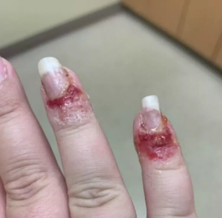    Вот так могут выглядеть последствия пудрового маникюра.Фото: соцсети