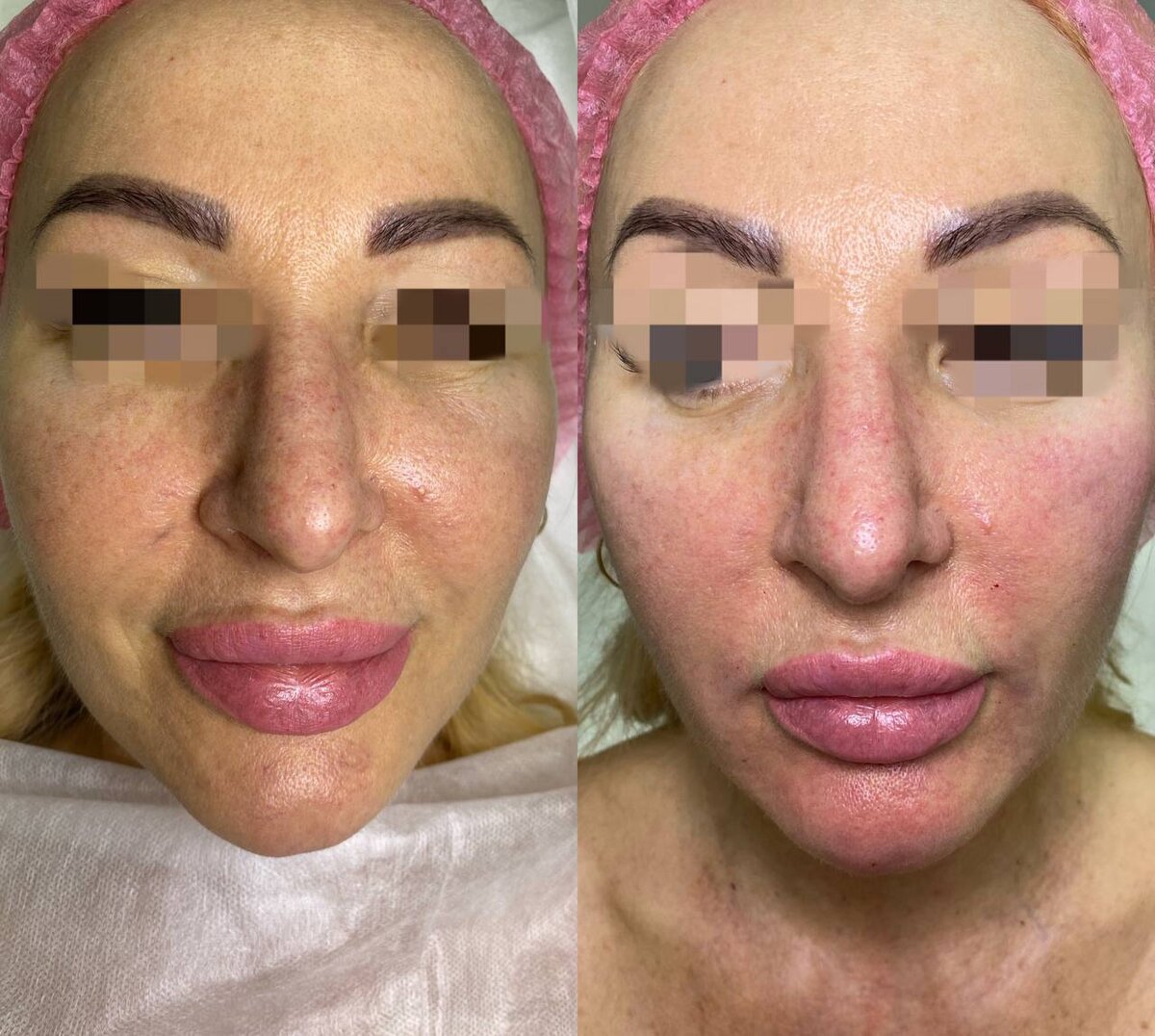 Клиент прошла курс биоревитализации 