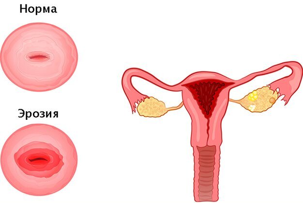 Отличие матки в норме от эрозии