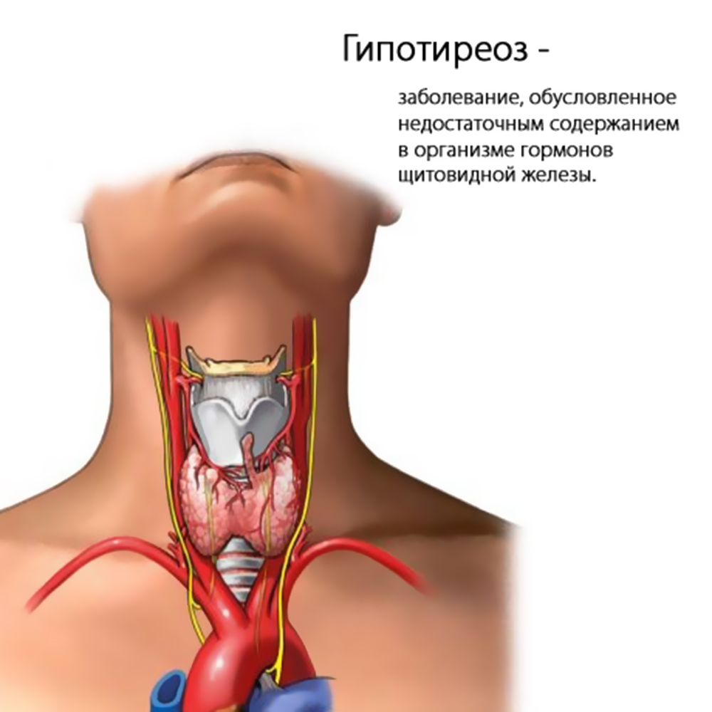 Мышечная слабость ног и в области тазобедренных суставов | Рідкісні захворювання