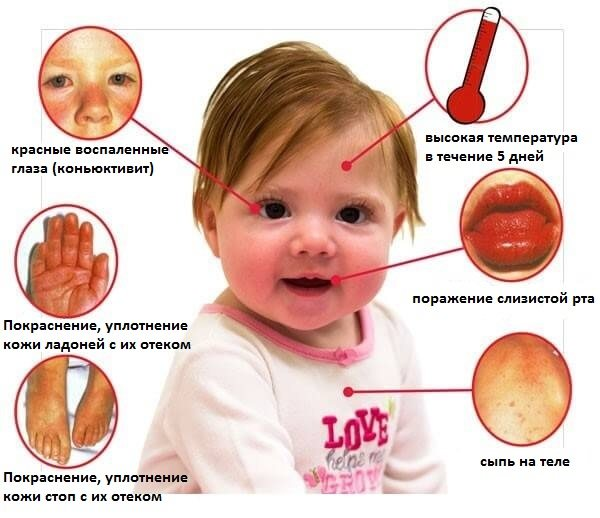 Diagnosis and Management of Kawasaki Disease AAFP