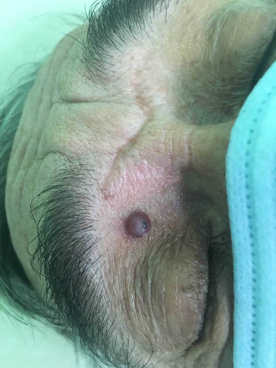 Пиогенная гранулёма 