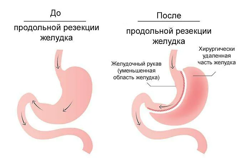 Бариатрическая операция резекция желудка. Продольная резекция желудка _Sleeve Gastrectomy. Операция рукавная гастропластика.