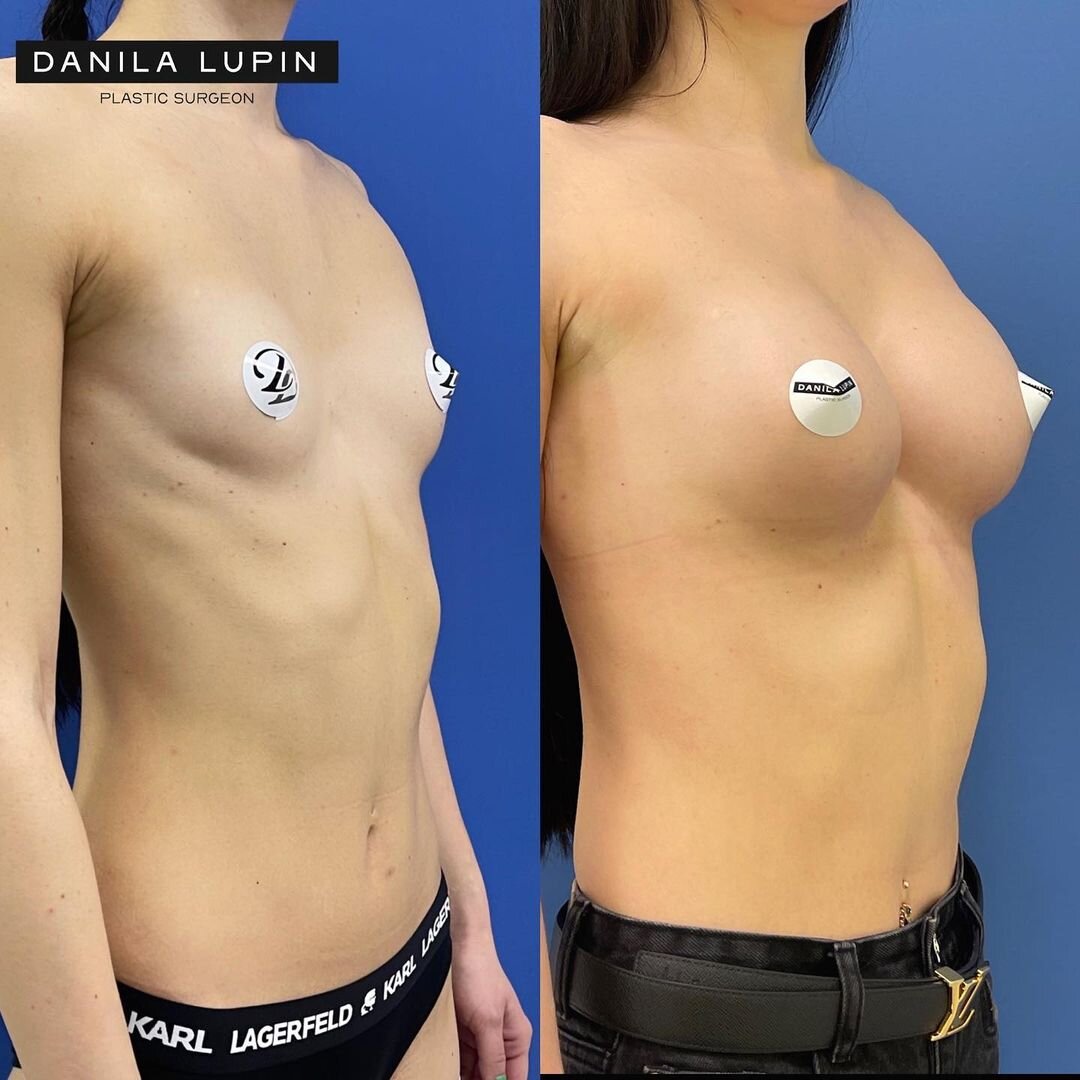 До и после маммопластики. На фото пациентка Данилы Лупина. Имеются противопоказания, необходима консультация специалиста