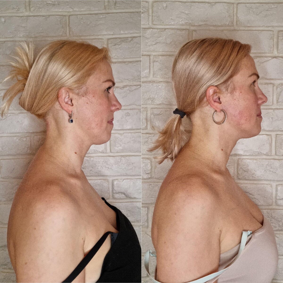 Фото слева ДО: зажатая шея, напряжённые мышцы шеи, имеются морщины. Справа ПОСЛЕ: шея расслабленная, кольца Венеры не выраженны 