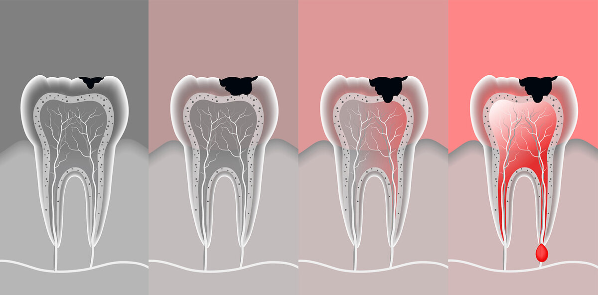 Лечение кисты зуба без удаления в домашних условиях