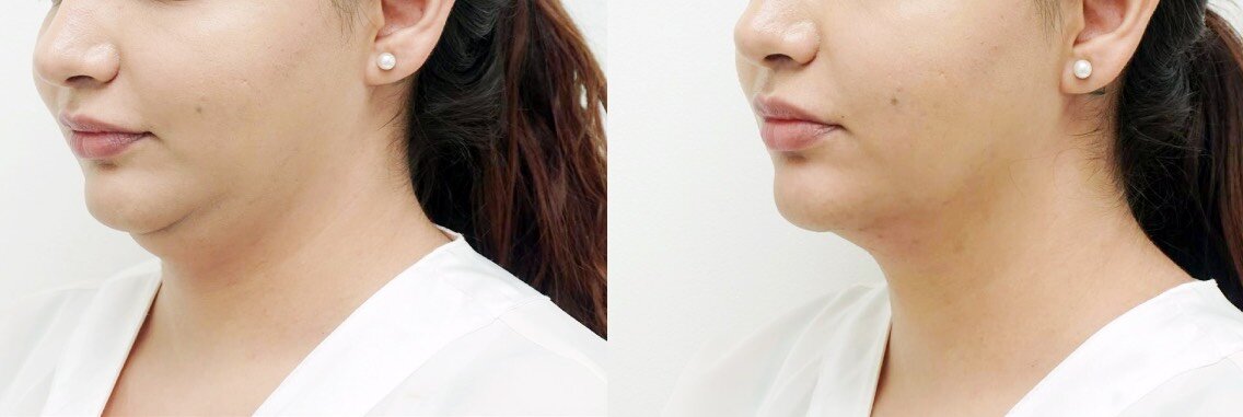 Криолиполиз для похудения: всемирный обман или это правда работает ...