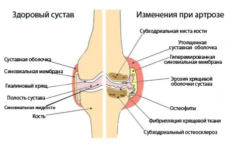 Болезнь Олье