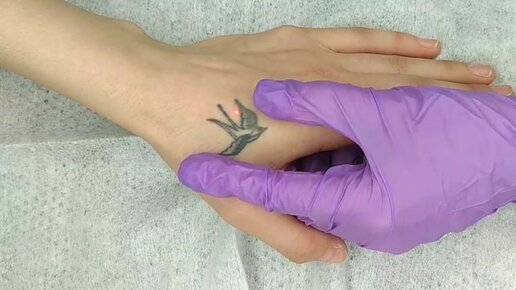 Лазерное удаление татуировки. Видео