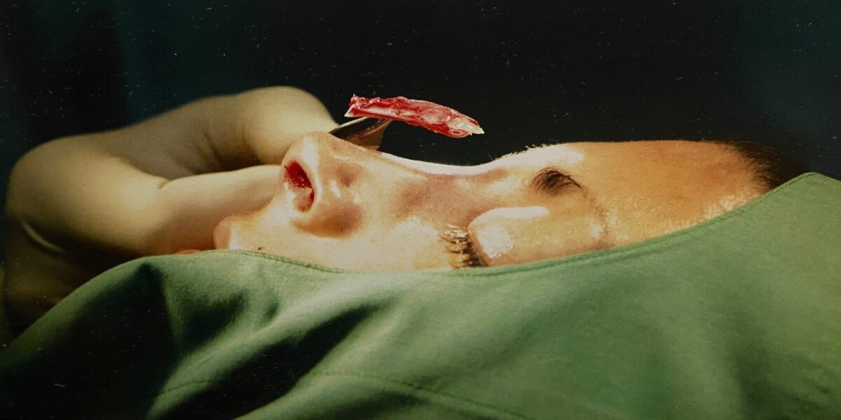 Ринопластика.