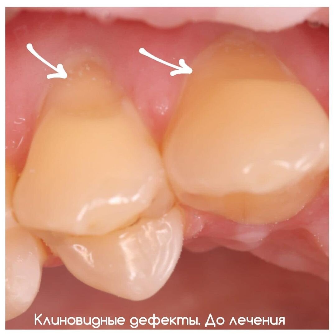 Кариес зубов на контакте | Юлия Селютина | Дзен