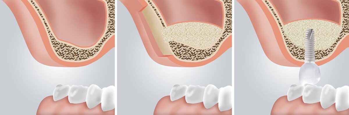 Этапы проведения синус лифтинга на верхней челюсти. Фото взято с сайта https://akademstom.ru/sinus/