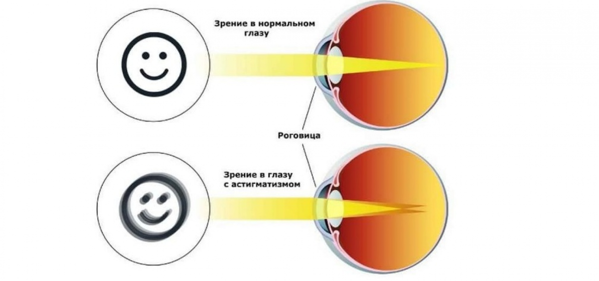 астигматизм фары машин