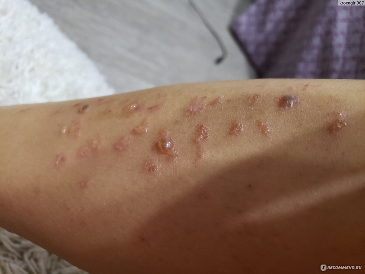 Термические ожоги. Лазер нагревает фолликул волоса и есть риск обжечь окружающую его кожу. Случается когда на аппарате плохая система охлаждения или за аппаратом малоквалифицированный персонал