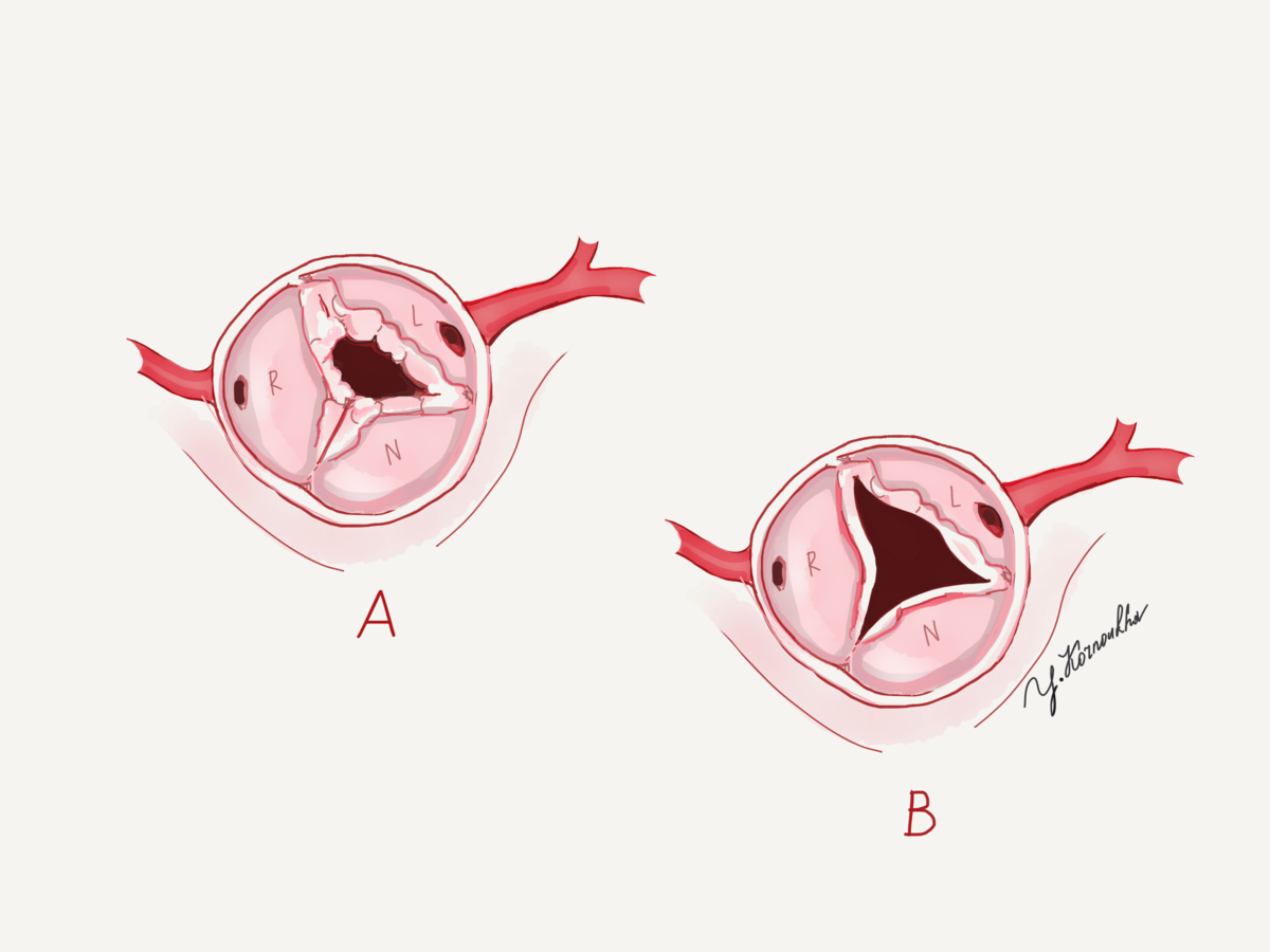    На картинке слева - стенозированный аортальный клапан (створки сращены), справа - нормальный.Рисунок: Ю.Ю. Корноухов