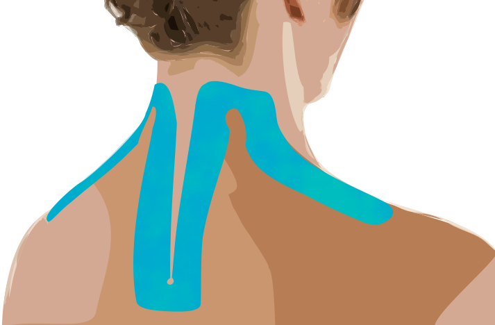 Тейпирование