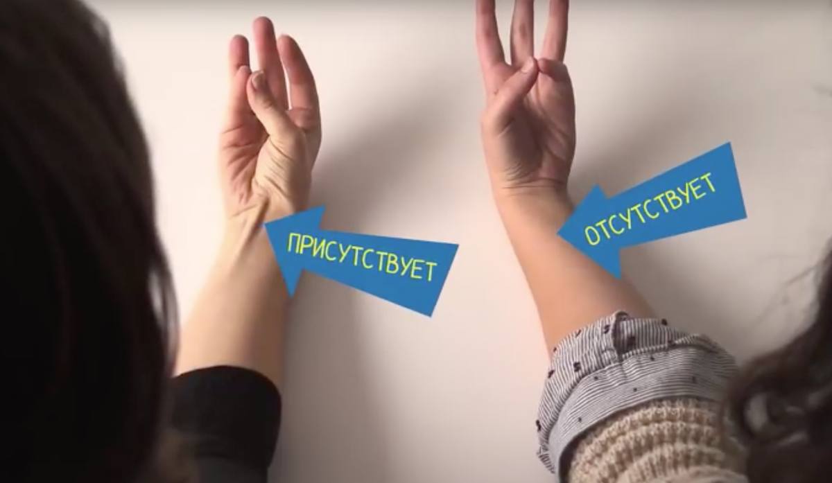 Рудиментарное сухожилие