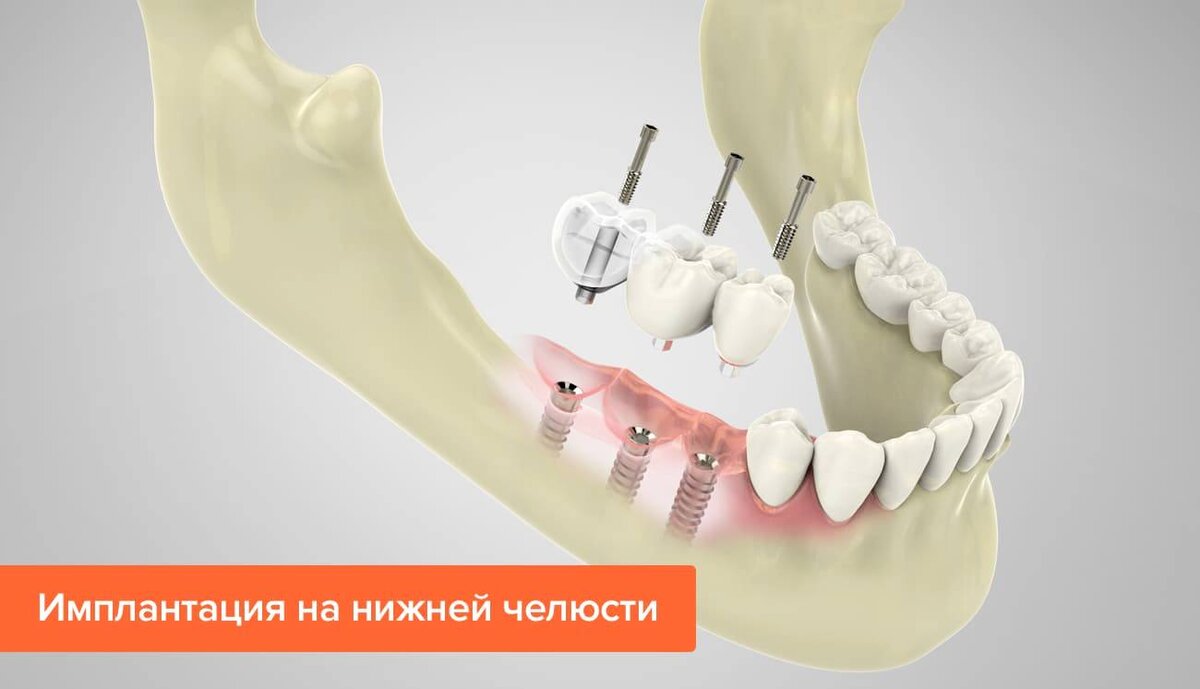 Нужно ли удалять зубы мудрости для успешной имплантации? | TopDent | Дзен