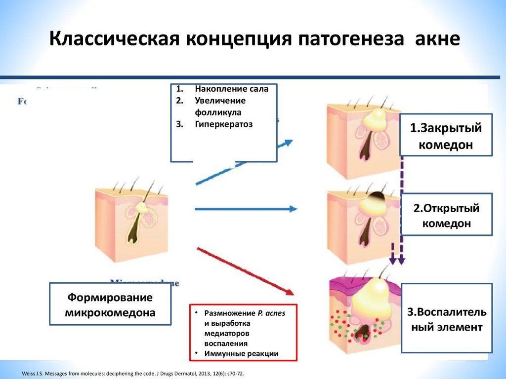 Акне на лице схема