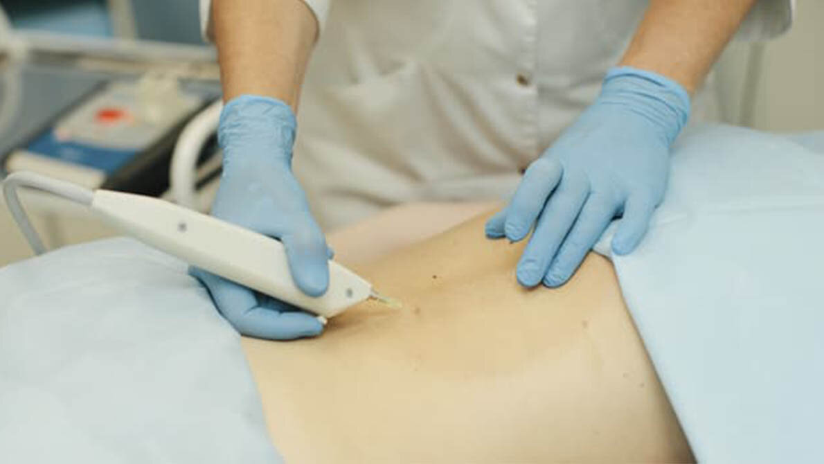 Процедура карбокситерапии