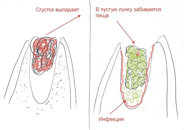 Альвеолит после удаления зуба - симптомы и лечение альвеолита