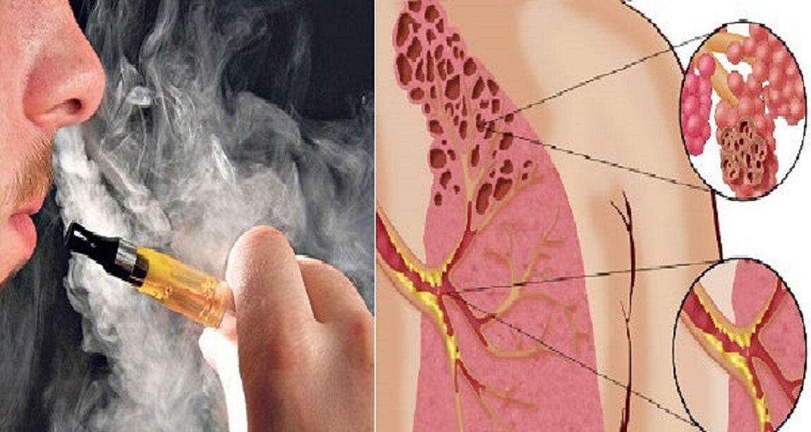 "Попкорная" болезнь