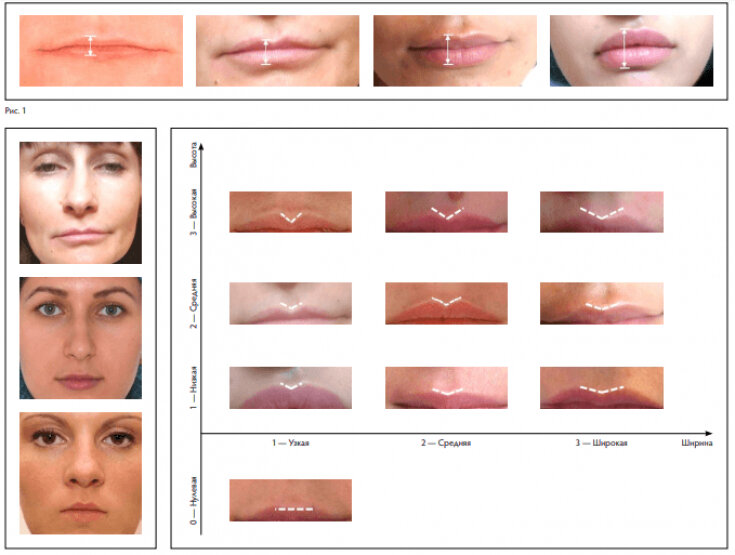 Размеры и формы женских губ: какая губа считается идеальной?