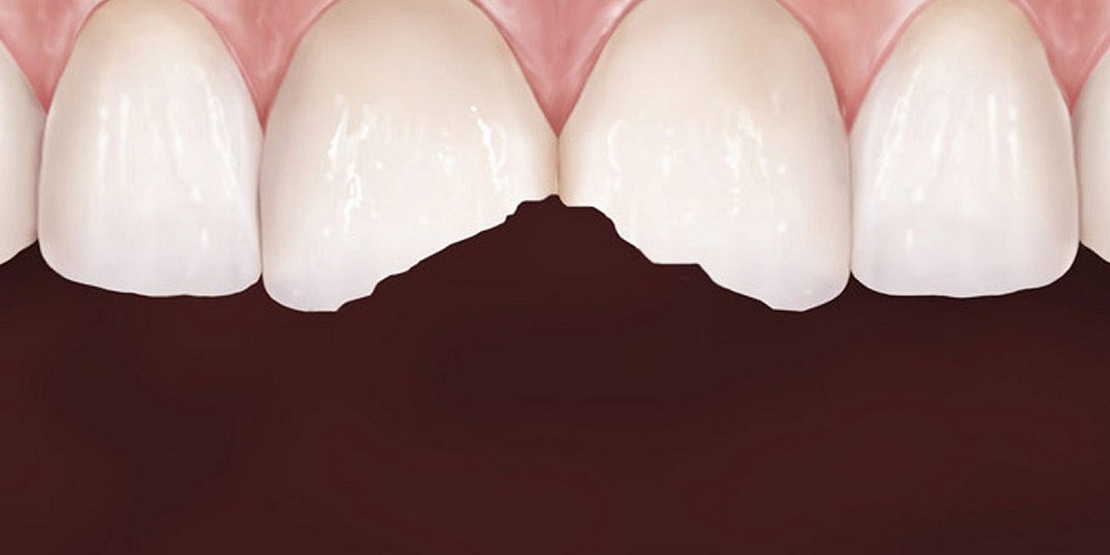 Крошатся зубы – причины, лечение