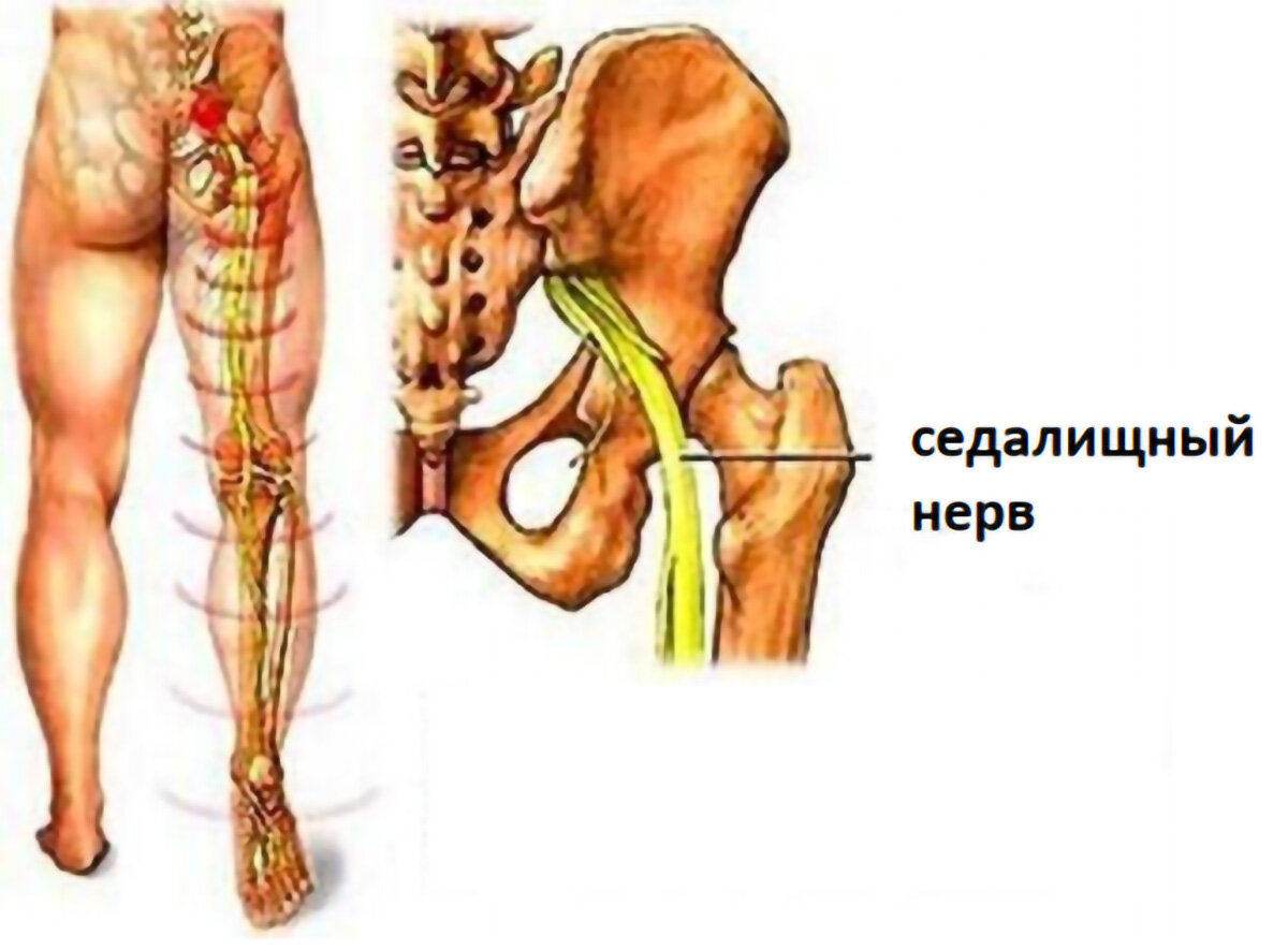 Люмбоишиалгия смп. Люмбоишиалгия поясничного отдела позвоночника. Люмбоишиалгия пояснично-крестцового отдела. Люмбоишиалгия слева. Люмбоишиалгия рентген.