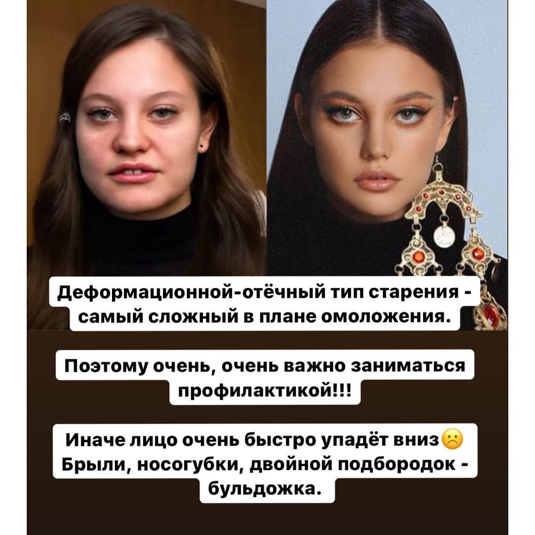 Деформационно-отёчный тип старения