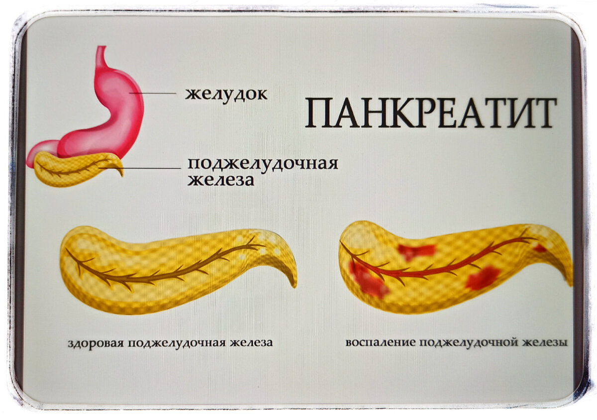 Диета при панкреатите