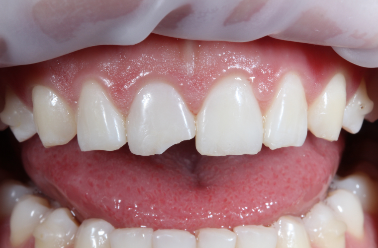 Случай скола зуба