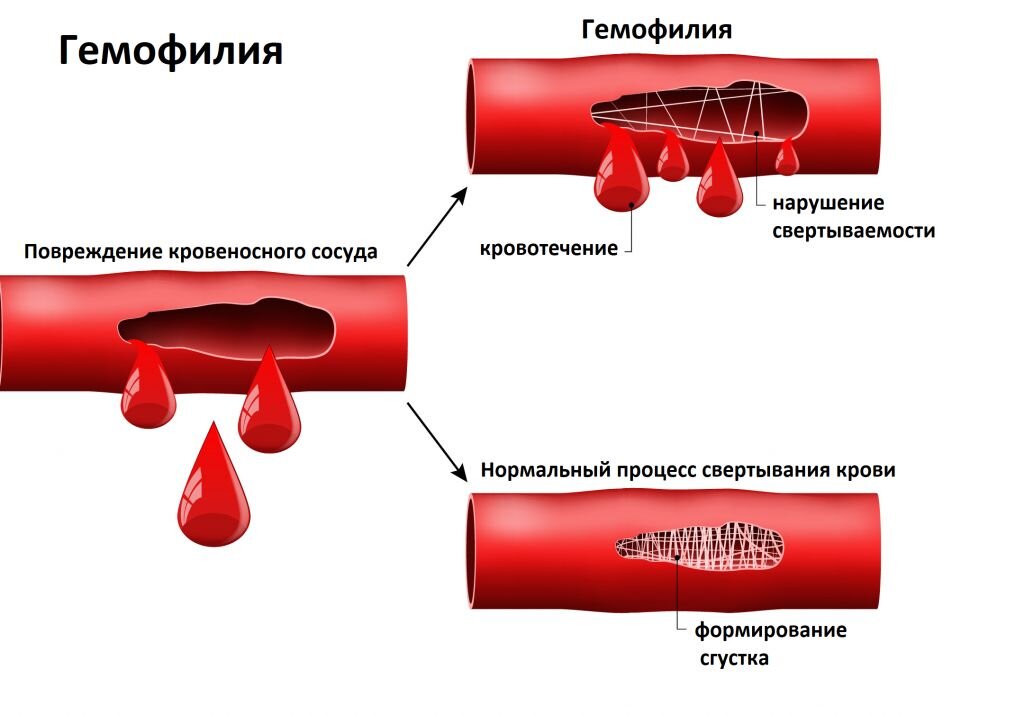 Гемофилия а презентация