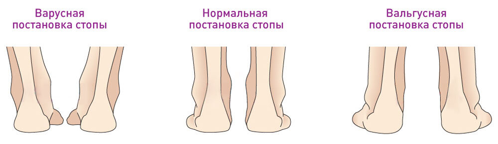 Вальгусная стопа и варусная стопа. Брусок для отталкивания. Брусок для отталкивания для прыжков в длину. Варусная и вальгусная деформация стоп. Х образная установка стоп.