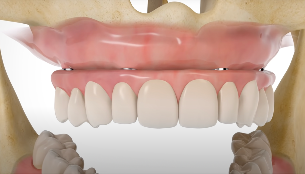 All-on-4 на верхней челюсти.