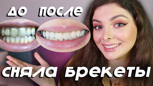 СНЯЛА БРЕКЕТЫ | ДО/ПОСЛЕ 😱 Довольна ли я результатом?