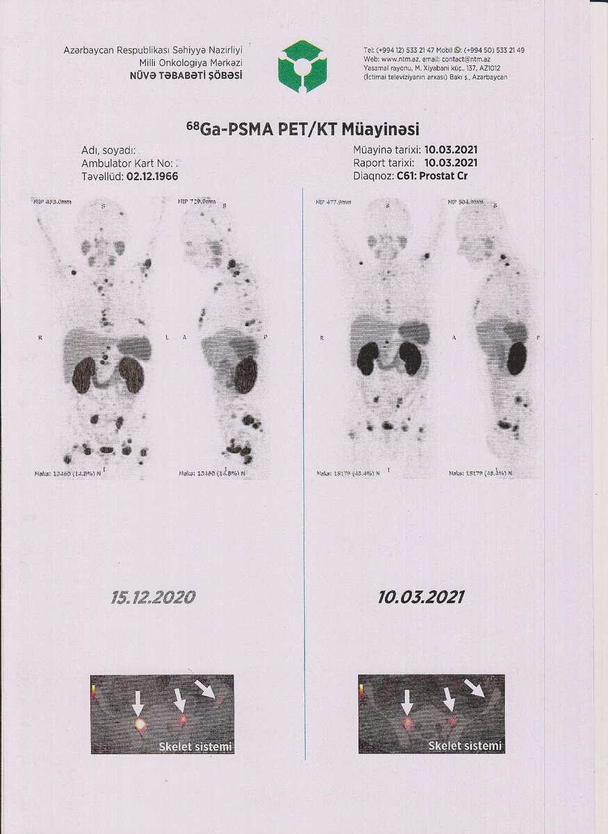 Динамика результатов ПЭТ-КТ исследований с PSMA-617, меченого изотопом 68Ga, в сравнение. Перед вторым курсом терапии в декабре и перед третьим курсом в марте этого года.