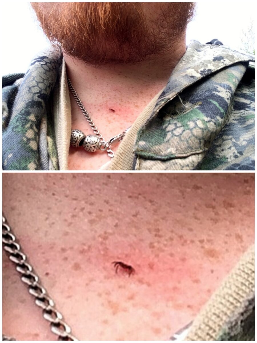 Во время сбора черники (июль месяц) активность клещей уже падает, но я все таки его подцепил, из-за неправильной одежды с открытыми частями тела