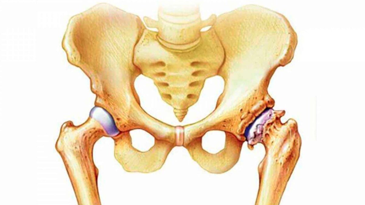 Лечение коксартроза (артроза тазобедренного сустава) в Санкт-Петербурге