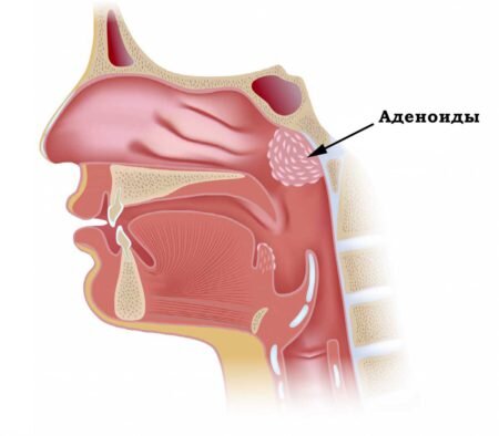 Аденоиды и Аденоидит часть 2 — ЛОР клиника №1