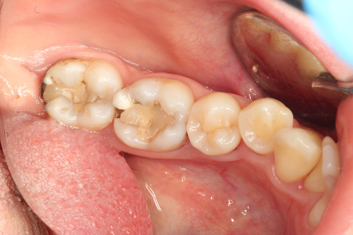 Пациент пришел на проф. осмотр, видим такую картину. Самое интересное, что его абсолютно ничего не беспокоит. Сегодня покажу семерку (последний зуб)