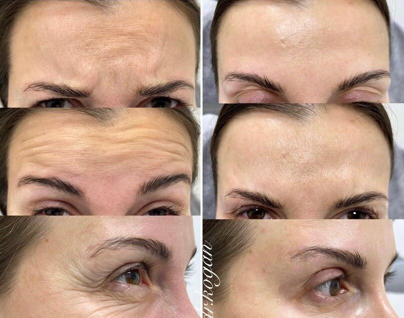 Ботулинотерапия фото до и после. Фото предоставлено врачом дерматологом косметологом клиники Д.Р. Гришкяна - Коган Л.С. Имеются противопоказания, требуется консультация специалиста