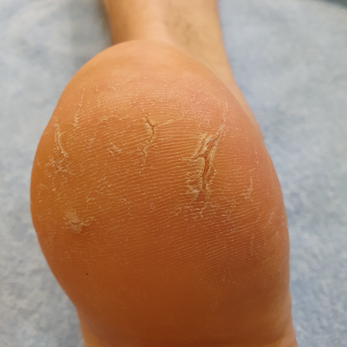 Начала образовываться трещина